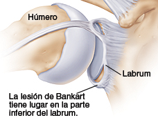 La lesión de Bankart es un muy común tras una luxación de hombro y es motivo de inestabilidad.