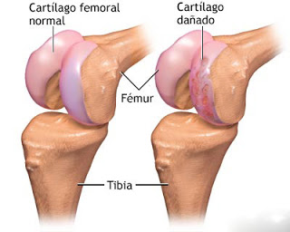 lesiones runner,lesiones corredor,músculos,tendones,piernas,tibias y rodillas
