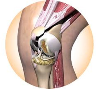 La artrosis de rodilla es la mayor causa de discapacidad en edad avanzada -  Surbone