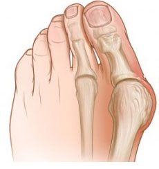 Gráfico donde se representa un caso típico de hallux valgus o juanente.