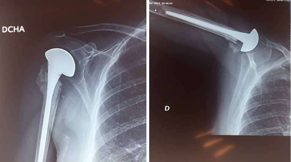 Radiografía donde se puede apreciar la colocación de la prótesis de hombro tras una realizada por los traumatólogos de Surbone