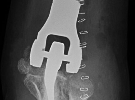 radiografia_codo_link