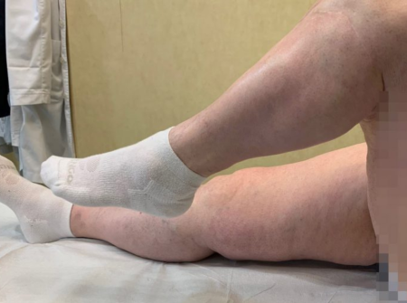 Facebook Infección Prótesis Rodilla